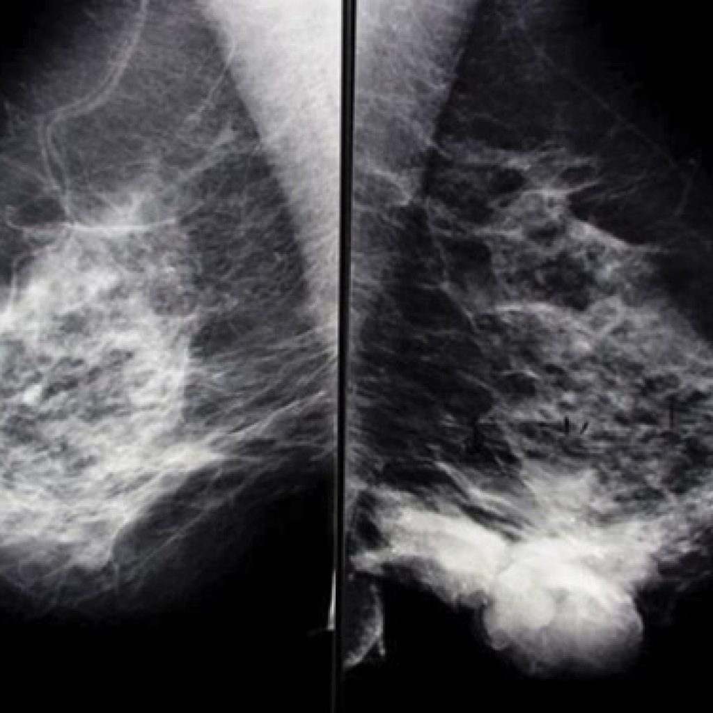 Figure 1 MLO film showing extent of disease in inferior part of left breast.