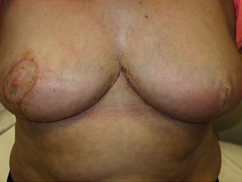Figure 4 Post operative result from left therapeutic mammoplasty maintaining good volume, shape and size of the breast albeit without nipple preservation. Right side standard reduction mammoplasty done utilising a superomedial pedicle.