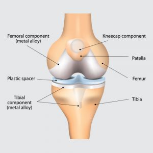 Total knee replacement surgery FAQs