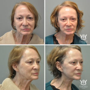 Facelifts: Art & Science