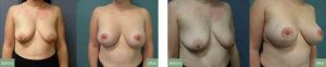 What happens when a patient requests a mastopexy (breast lift)