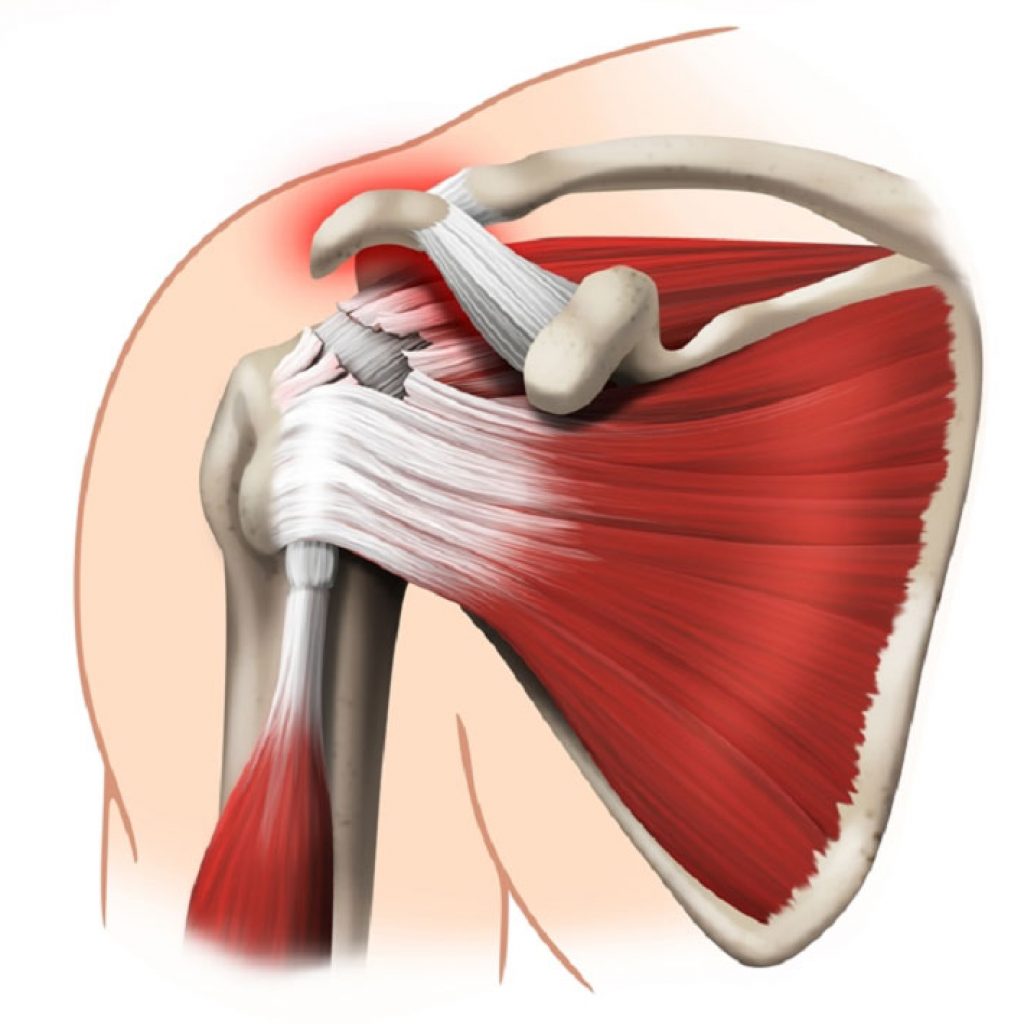 Understanding the natural history of rotator cuff tears is helpful in developing treatment algorithms. Rotator cuff pathology is the most common cause of shoulder disability and becomes more prevalent with age.
